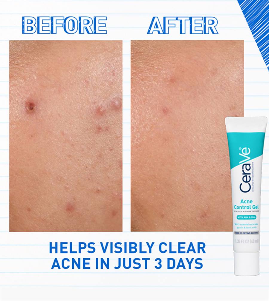 Acne Control Gel - Image 3