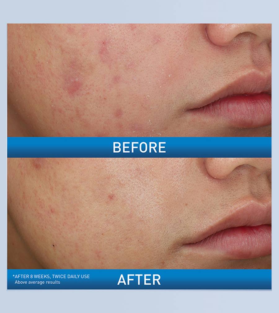 Acne Foaming Cream Wash - Image 3